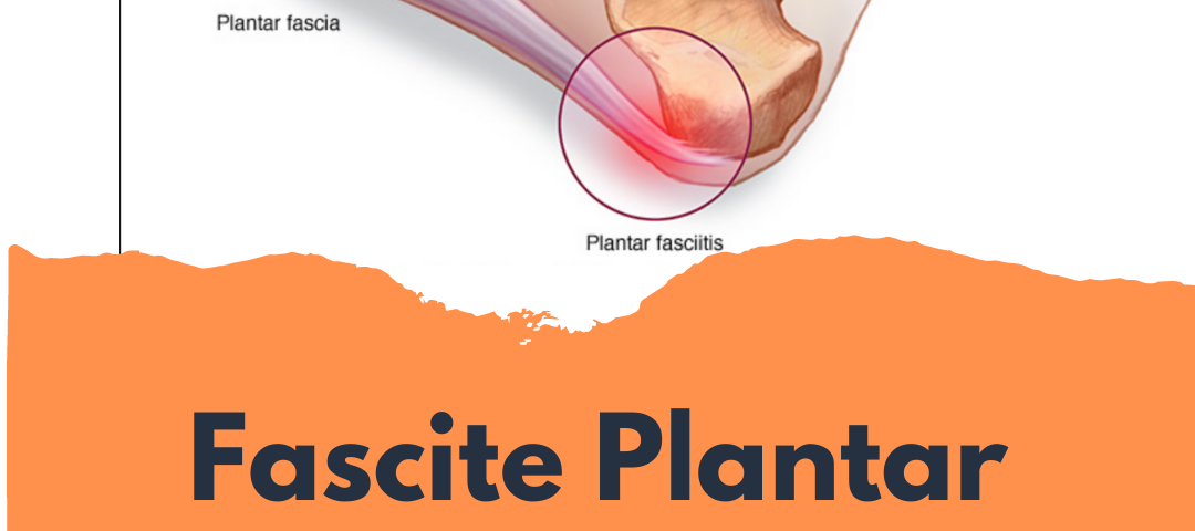 Fascite Plantar MUVI Palmilhas Posturais